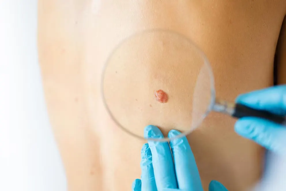 Vacuna personalizada contra el cáncer mejora supervivencia en melanoma avanzado